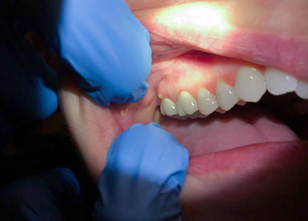 Best Emergency Tooth Extraction in Seco Mines, TX